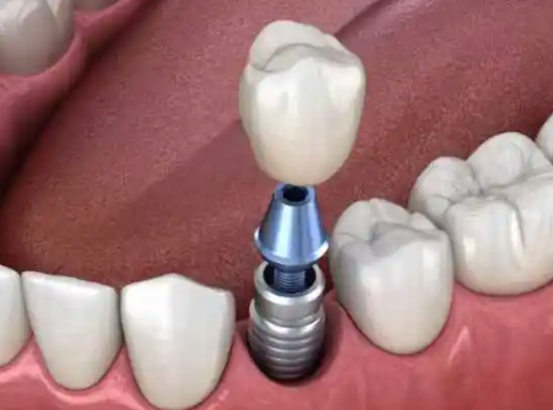 多地医保局调查费用 种植牙集采加速推进